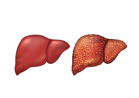 هر آنچه باید درباره کبد چرب بدانید