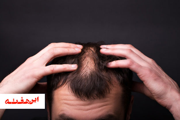 فریب سودجو ها در زمینه کاشت مو را نخورید