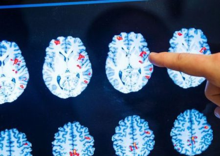 دو خبر ‘امیدوارکننده’ از درمان سرطان مغز