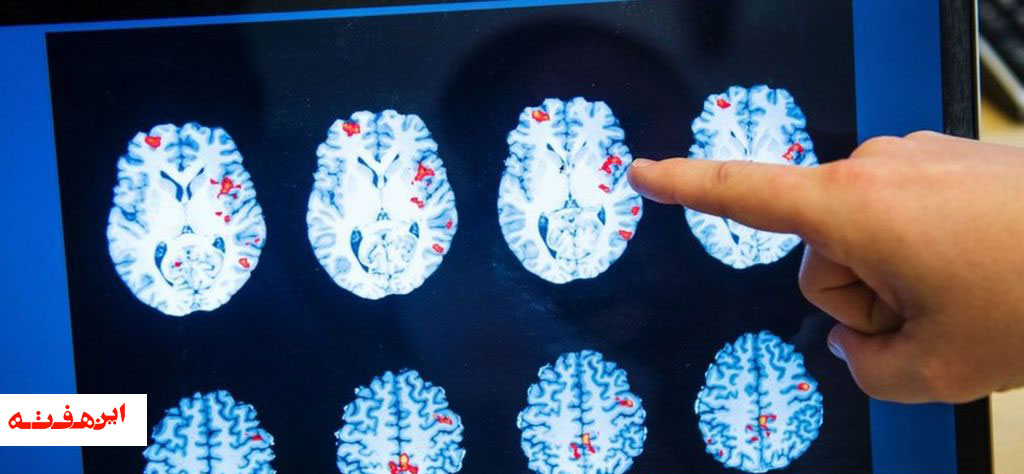 دو خبر ‘امیدوارکننده’ از درمان سرطان مغز